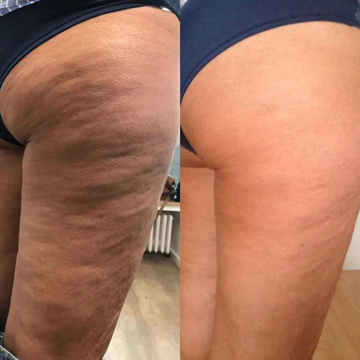 Velina™ Anti-Cellulite Massage Oil